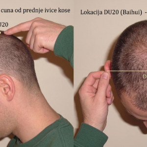 Hipotenzija (nizak krvni pritisak) - uzroci, prirodna rešenja i akupresurne tačke