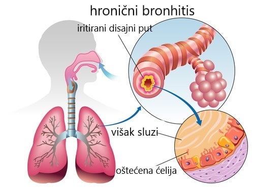hronicni bronhitis zagadjenje vazduha