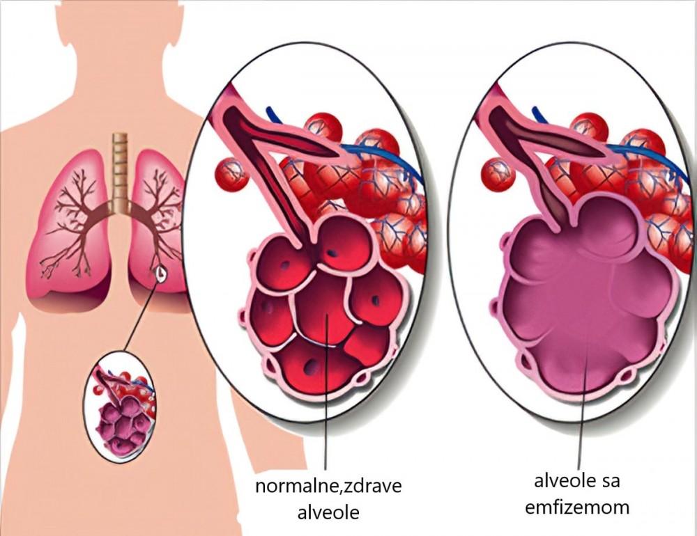 alveole i zagadjenje vazduha efekti